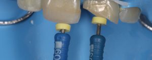 Intensivo endodoncia